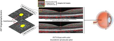 Liver fibrosis and retinal features in an older Mediterranean population: Results from the Salus in Apulia study